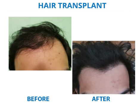 FUE hair transplant cost in delhi