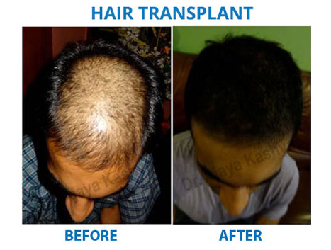 beard hair transplant in delhi