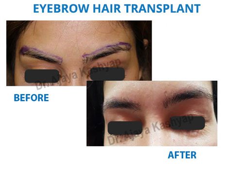 hair transplant clinic near me