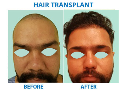 hair transplant clinic in delhi